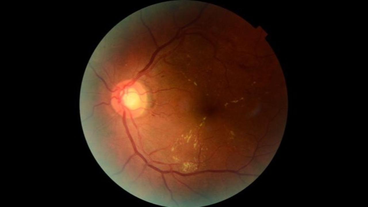 Desarrollada por investigadores del CONICET y la Universidad Nacional del Centro de la Provincia de Buenos Aires, la plataforma utiliza inteligencia artificial para detectar tempranamente signos de retinopatía diabética. Ya funciona en hospitales de Tandil, Florencio Varela y Necochea.

