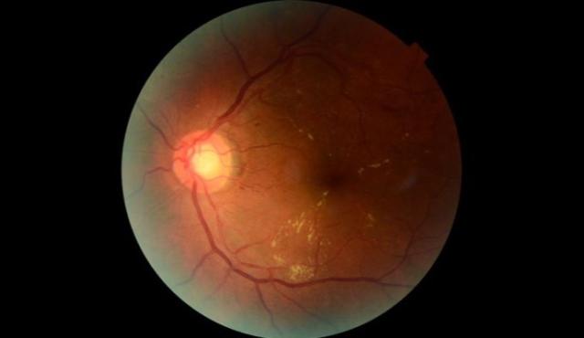 Desarrollada por investigadores del CONICET y la Universidad Nacional del Centro de la Provincia de Buenos Aires, la plataforma utiliza inteligencia artificial para detectar tempranamente signos de retinopatía diabética. Ya funciona en hospitales de Tandil, Florencio Varela y Necochea.
